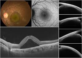 Flat irregular pigment epithelial detachment over time and outcome of different treatment regimens
